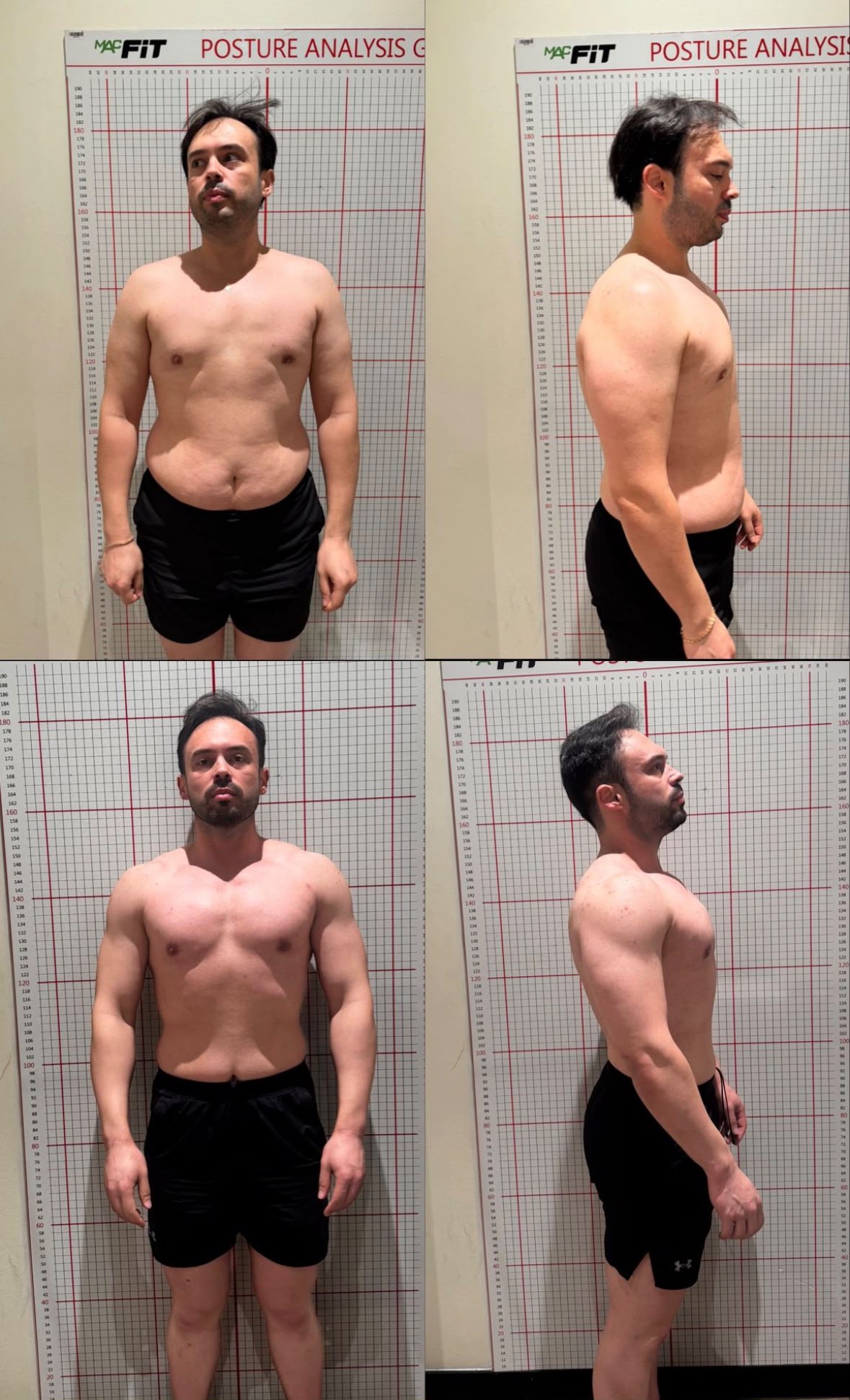 Erkek Danışan önce ve sonra fotoğrafı